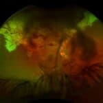 A Blow to the Eye: Managing Traumatic Eye Disease from Commotio Retinae to Macular Hole: A Case Report