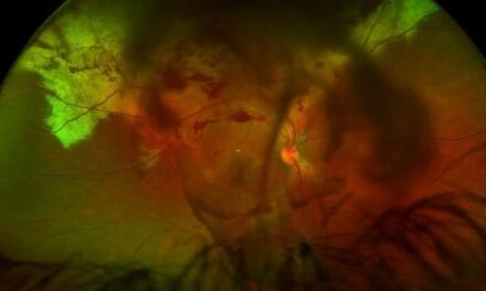 A Blow to the Eye: Managing Traumatic Eye Disease from Commotio Retinae to Macular Hole: A Case Report