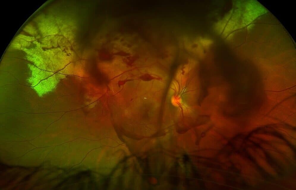 A Blow to the Eye: Managing Traumatic Eye Disease from Commotio Retinae to Macular Hole: A Case Report