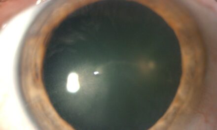 Central Corneal Pseudomicrocysts Resultant from Belantamab Mafodotin Therapy: A Case Report