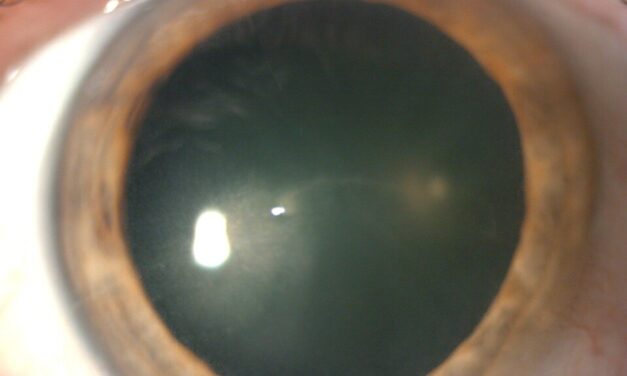 Central Corneal Pseudomicrocysts Resultant from Belantamab Mafodotin Therapy: A Case Report