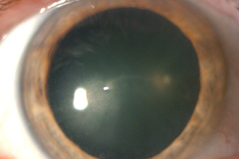 Central Corneal Pseudomicrocysts Resultant from Belantamab Mafodotin Therapy: A Case Report